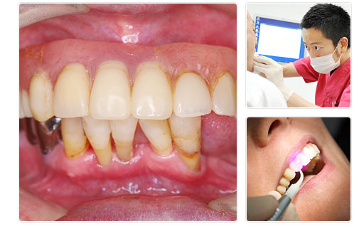 「歯周病」1カ月改善プログラム